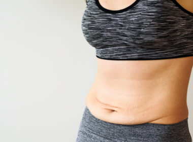 A close-up of a woman's belly, showing stretch marks and loose skin, which are the result of weight loss.