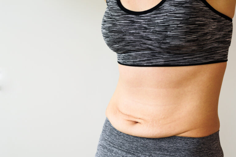 A close-up of a woman's belly, showing stretch marks and loose skin, which are the result of weight loss.