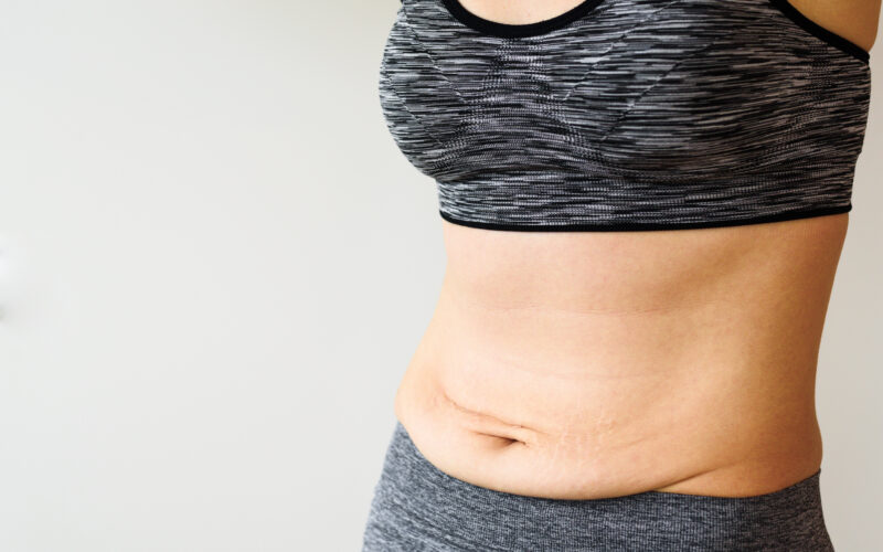 A close-up of a woman's belly, showing stretch marks and loose skin, which are the result of weight loss.